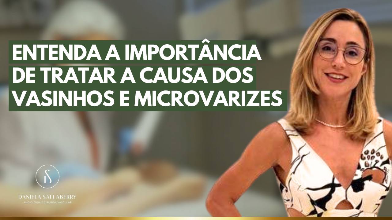 Entenda a importância de tratar a CAUSA dos Vasinhos e Microvarizes