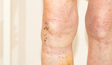 DSallaberry_Endolaser-9