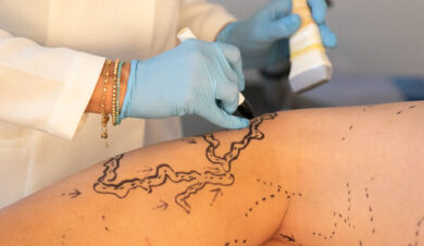 DaniSallaberryEndolaserMasculino-38